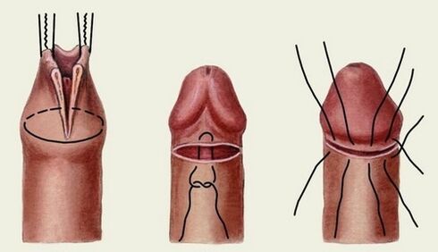penis büyütme ameliyatının özü
