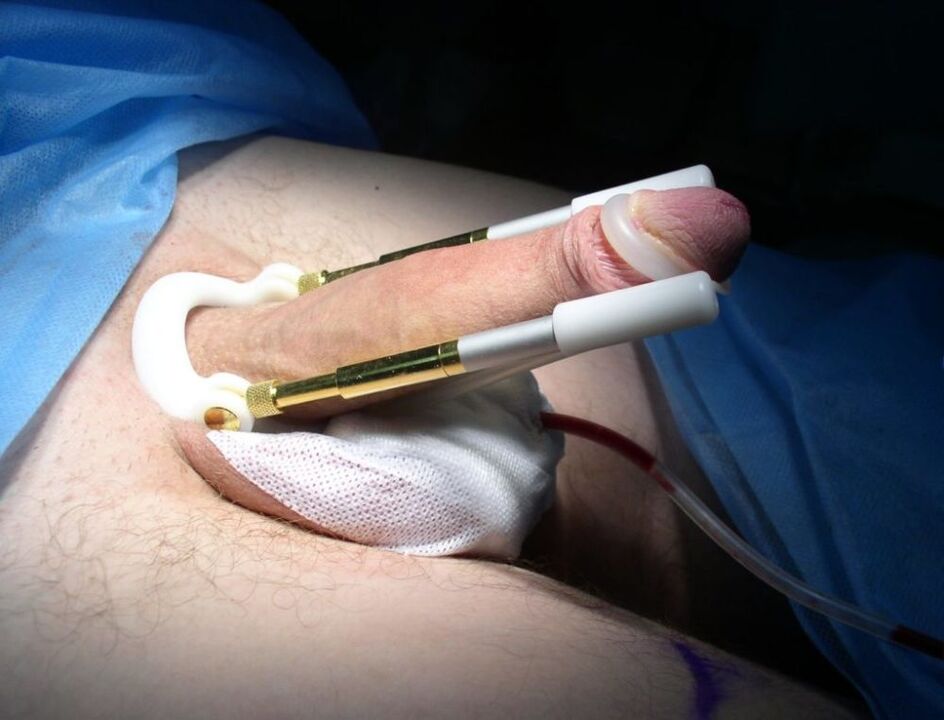 penis büyütme ameliyatı sonrası uzatma