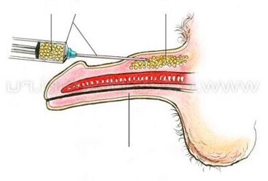 enjeksiyon penis büyütme