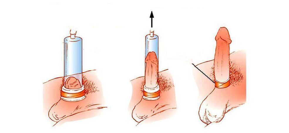 penis vakum pompası nasıl çalışır